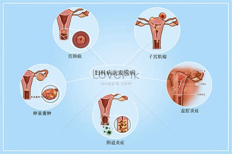 婦科病